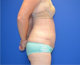 Tummy Tuck