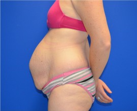 Tummy Tuck