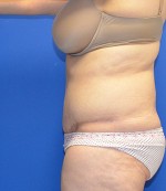 Tummy Tuck