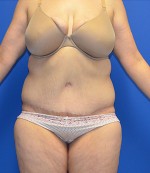 Tummy Tuck