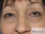 Blepharoplasty