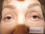 Blepharoplasty