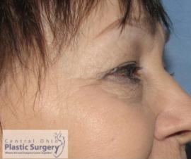 Blepharoplasty