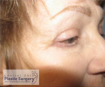 Blepharoplasty