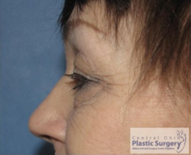 Blepharoplasty