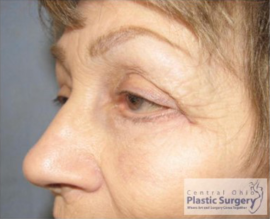 Blepharoplasty