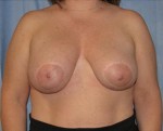 Breast Augmentation