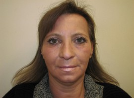 Fraxel Repair Facial Resurfacing