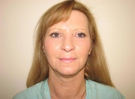 Fraxel Repair Facial Resurfacing