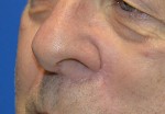 Skin Cancer Reconstruction