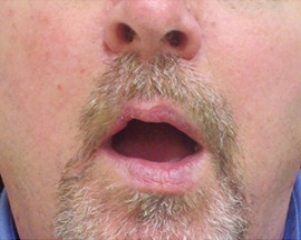 Skin Cancer Reconstruction