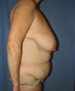 Tummy Tuck