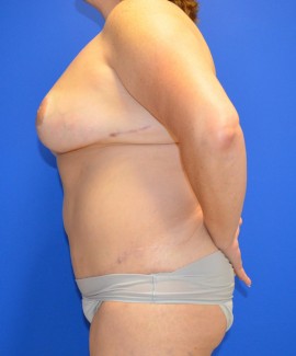 Tummy Tuck