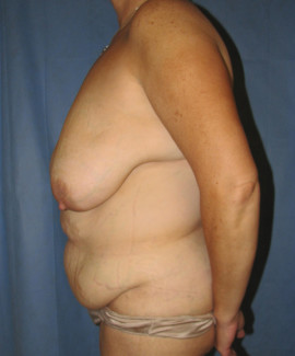 Tummy Tuck