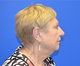 Facelift & Necklift