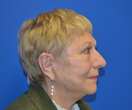 Facelift & Necklift