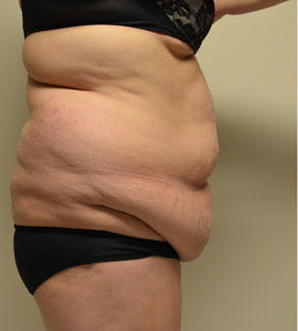 Tummy Tuck