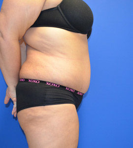 Tummy Tuck