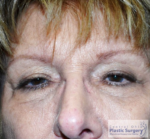 Blepharoplasty