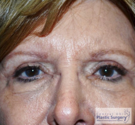 Blepharoplasty