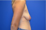 Breast Augmentation