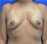 Breast Augmentation