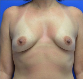 Breast Augmentation