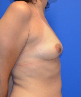 Breast Augmentation