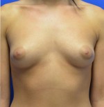 Breast Augmentation