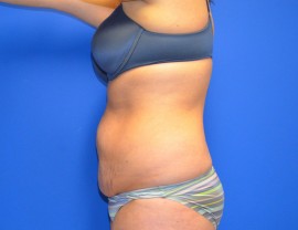 Tummy Tuck