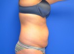 Tummy Tuck