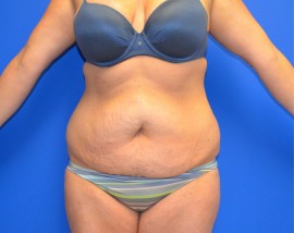 Tummy Tuck