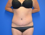 Tummy Tuck