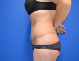 Tummy Tuck