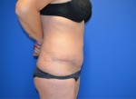 Tummy Tuck