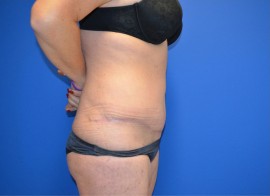 Tummy Tuck