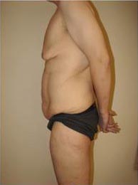 Male Breast Reduction (Gynecomastia)