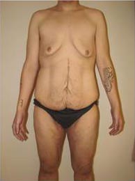 Male Breast Reduction (Gynecomastia)