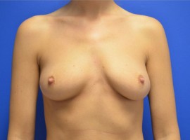 Breast Augmentation