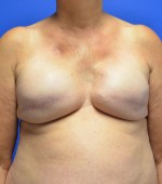 Breast Reconstruction