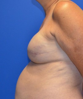 Breast Reconstruction