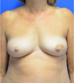 Breast Reconstruction