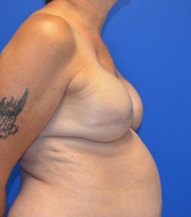 Breast Reconstruction