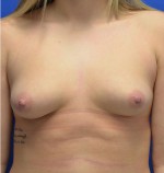 Breast Augmentation