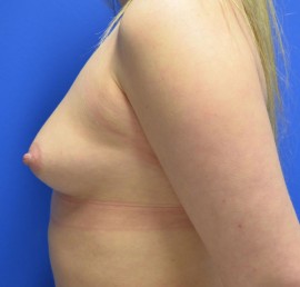 Breast Augmentation