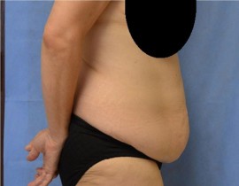 Tummy Tuck