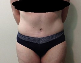 Tummy Tuck