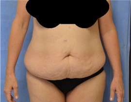 Tummy Tuck