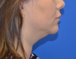 Kybella