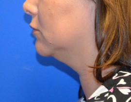 Kybella